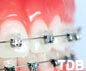 damon braces dental clinic thailand, damon orthodontics dental clinic thailand